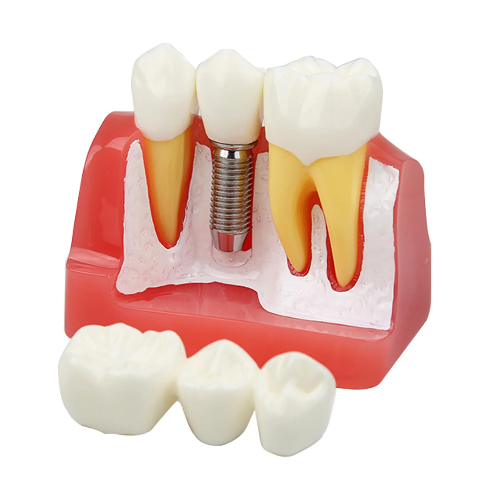 Dental Implant Model Removable Crown Bridge 4 Teeth Demonstration Model for Teaching Demonstration, Patient Education and Student Learning - Image 3