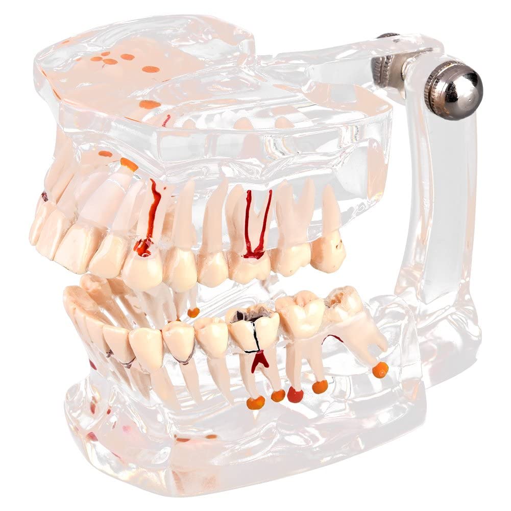 Walfront Model with removable teeth, transparent, implant, disease, teaching, standard teeth, model pathological demonstration
