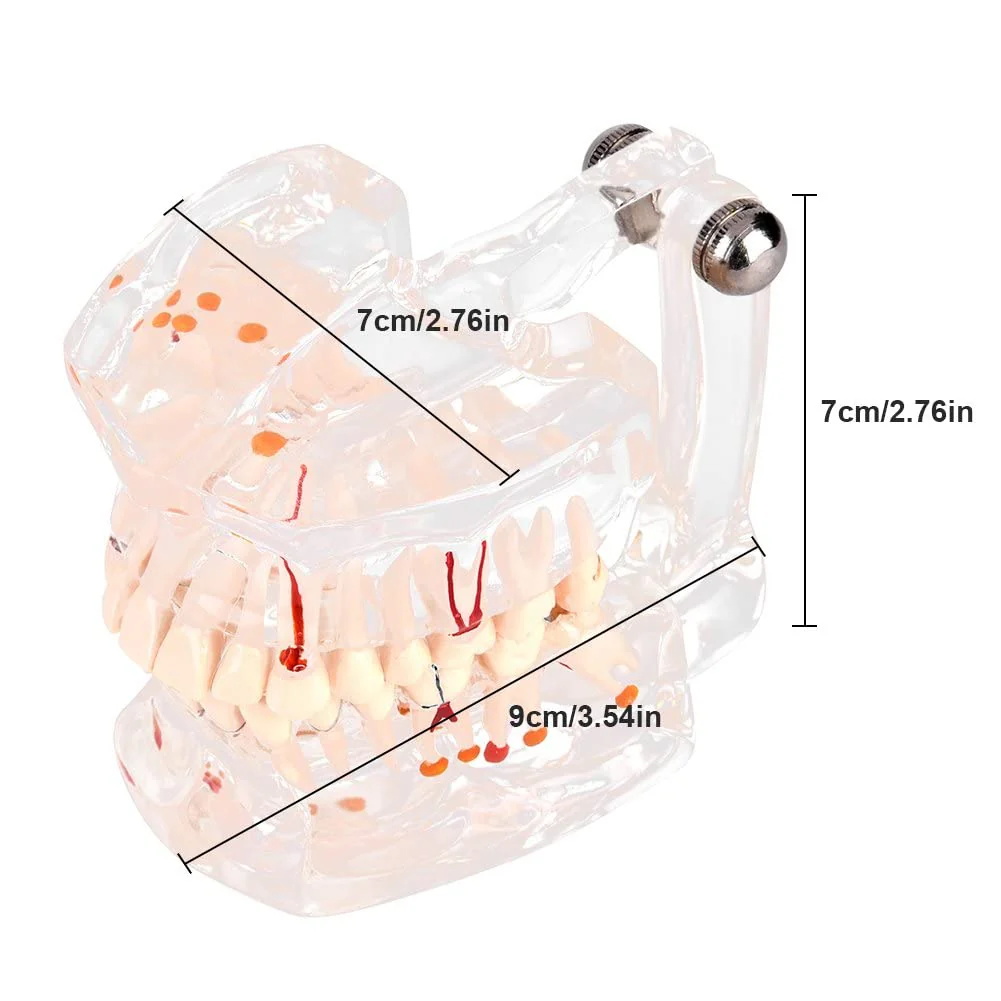 Walfront Model with removable teeth, transparent, implant, disease, teaching, standard teeth, model pathological demonstration - Image 3