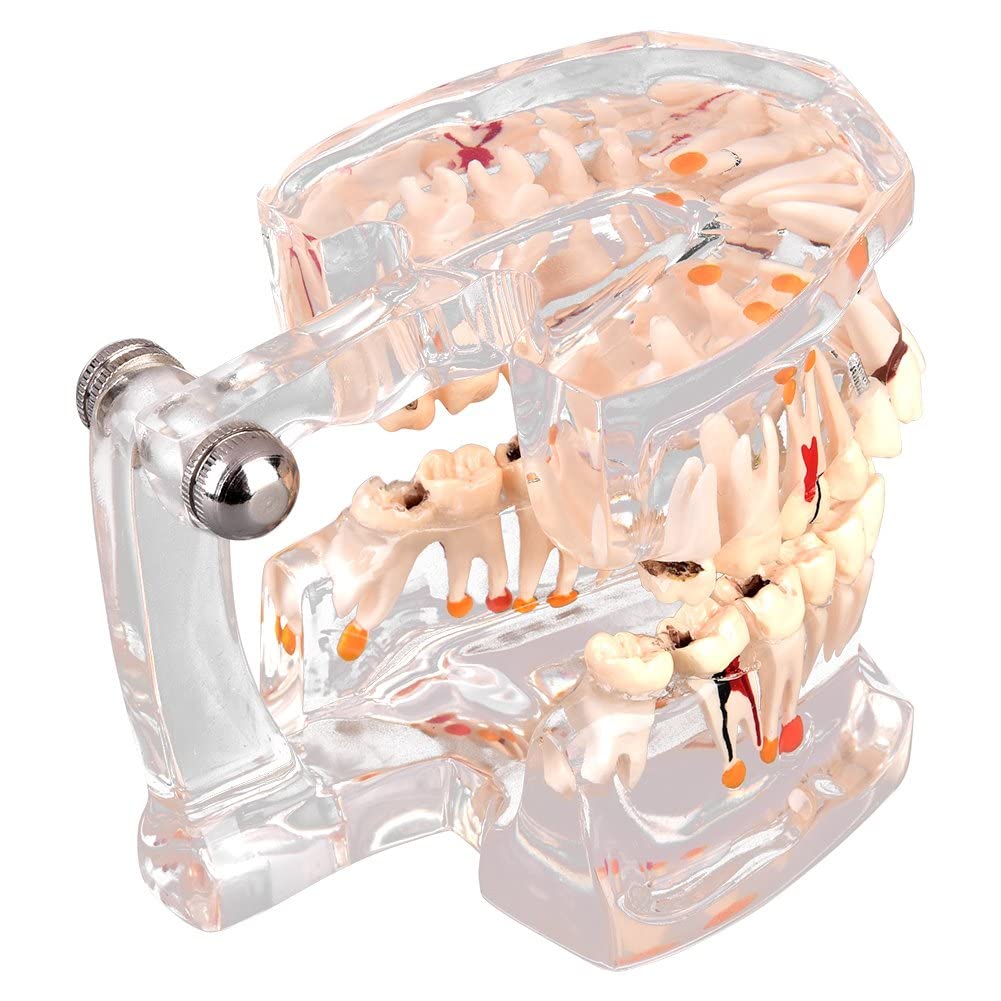 Walfront Model with removable teeth, transparent, implant, disease, teaching, standard teeth, model pathological demonstration - Image 6
